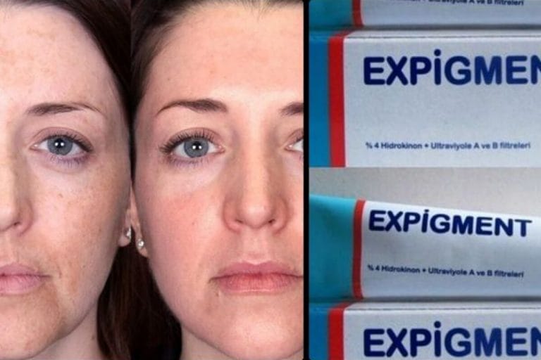 Expigment Krem Ne İşe Yarar?